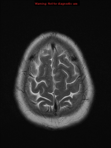 File:Neuroglial cyst (Radiopaedia 10713-11184 Axial T2 3).jpg