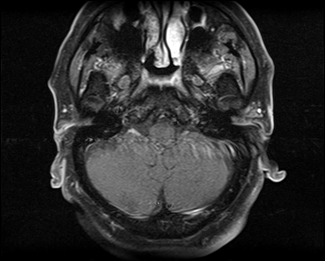 File:Non-Hodgkin lymphoma - parotid gland (Radiopaedia 71531-81890 Axial T1 C+ fat sat 21).jpg