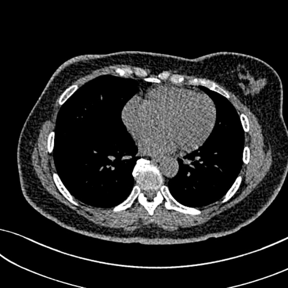 Normal CT chest- adult female (Radiopaedia 52522-58428 Axial non-contrast 84).jpg