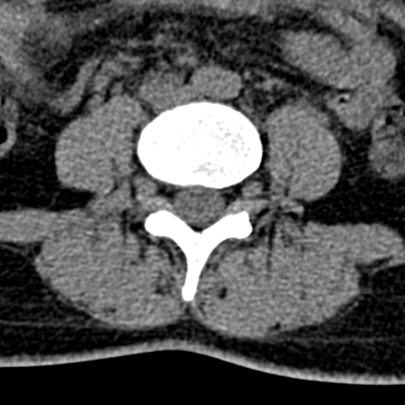 Normal CT lumbar spine (Radiopaedia 53981-60118 Axial non-contrast 67).jpg
