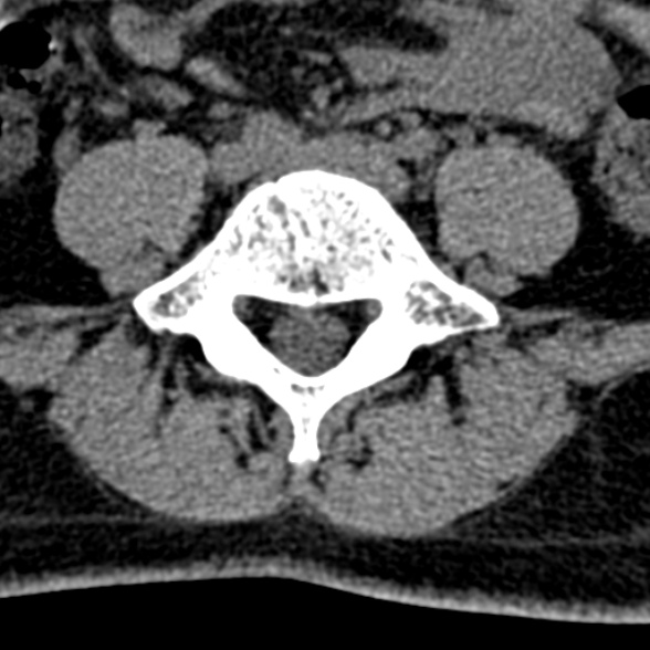 Normal CT lumbar spine (Radiopaedia 53981-60118 Axial non-contrast 78).jpg