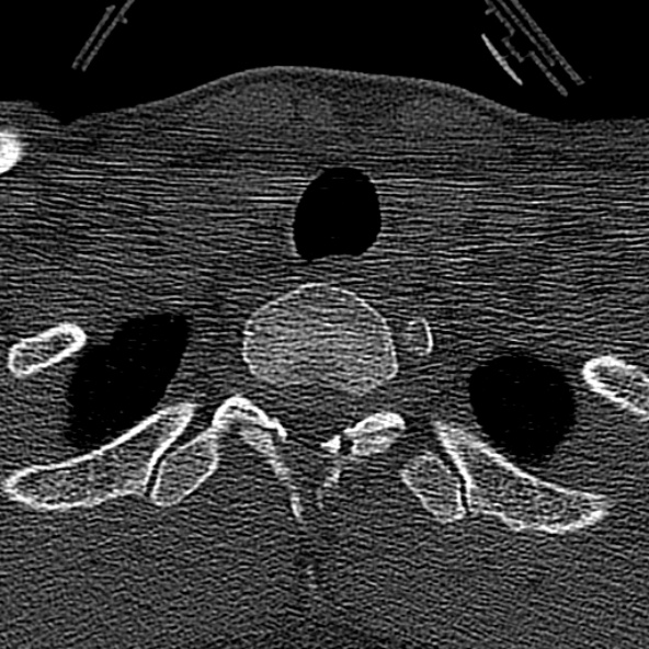 Normal CT of the cervical spine (Radiopaedia 53322-59305 Axial bone window 245).jpg