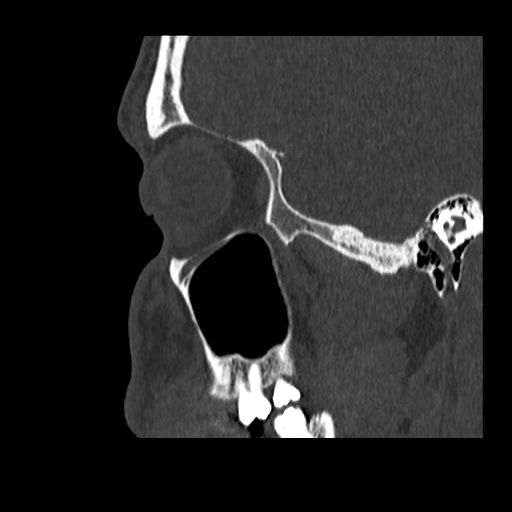 Normal CT paranasal sinuses (Radiopaedia 42286-45390 Sagittal bone window 82).jpg