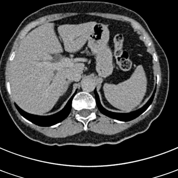 File:Normal CT split bolus study of the renal tract (Radiopaedia 48631-53634 Axial split bolus 7).jpg