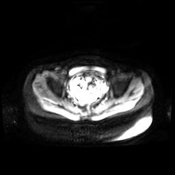 Normal MRI abdomen in pregnancy (Radiopaedia 88001-104541 Axial DWI 4).jpg