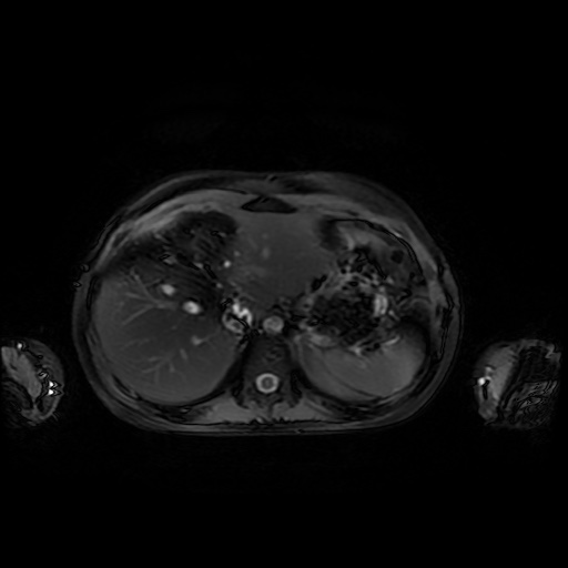 File:Normal MRI abdomen in pregnancy (Radiopaedia 88001-104541 D 10).jpg