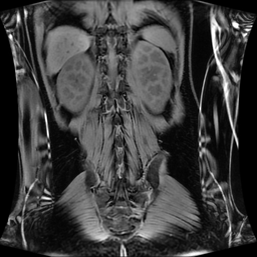 Normal MRI abdomen in pregnancy (Radiopaedia 88001-104541 M 111).jpg