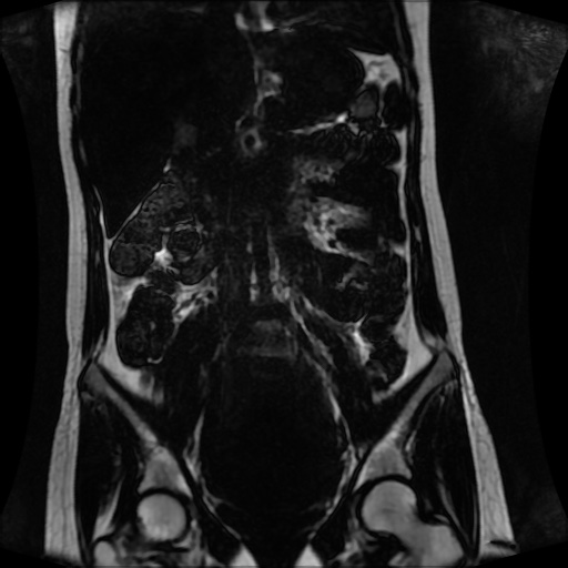 Normal MRI abdomen in pregnancy (Radiopaedia 88001-104541 N 72).jpg