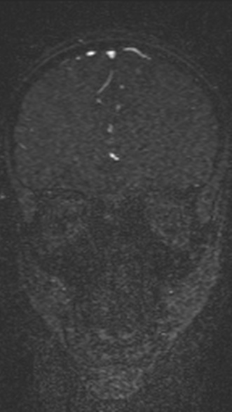 Normal MRI brain with MRV- teenager (Radiopaedia 49425-54553 Coronal MRV 80).jpg