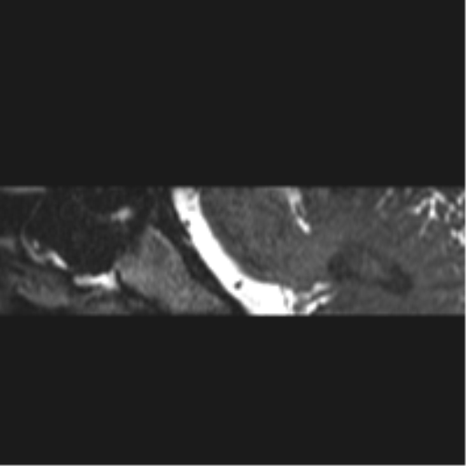 Normal MRI internal auditory canal (Radiopaedia 41613-44525 C 50).png