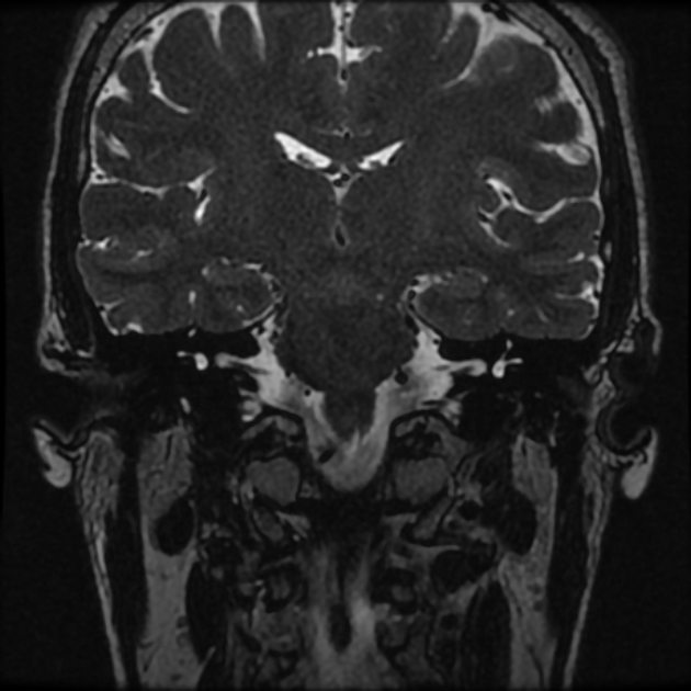 Normal MRI petrous (Radiopaedia 91317-108949 Coronal T2 51).jpg