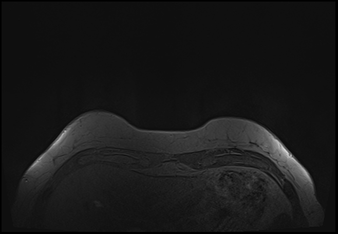 File:Normal breast MRI - dense breasts (Radiopaedia 80454-93850 Axial T1 12).jpg