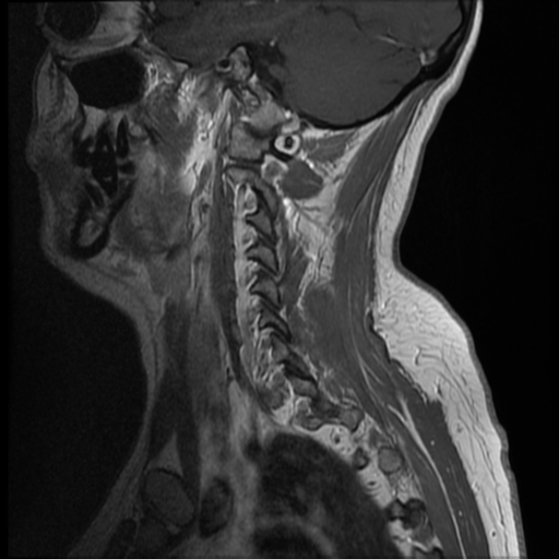 File:Normal cervical and thoracic spine MRI (Radiopaedia 35630-37156 Sagittal T1 C+ 1).png