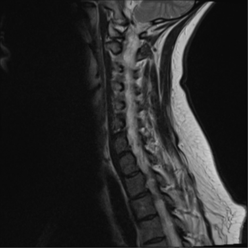 File:Normal cervical spine MRI (including Dixon) (Radiopaedia 42762-45925 Dixon- in-phase 11).png