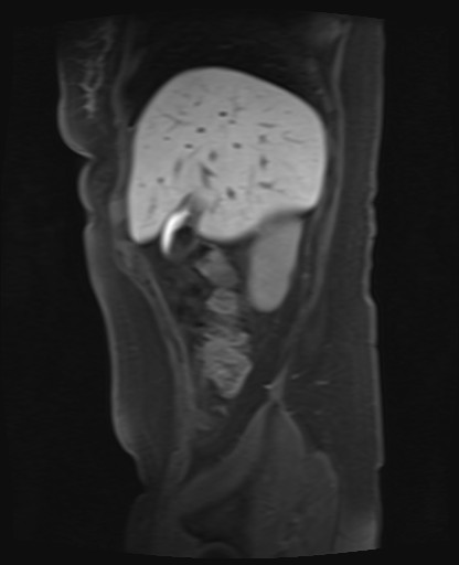 File:Normal hepatobiliary phase liver MRI (Radiopaedia 58968-66230 C 17).jpg