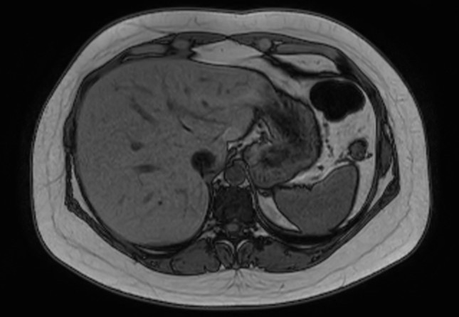 File:Normal liver MRI with Gadolinium (Radiopaedia 58913-66163 B 24).jpg