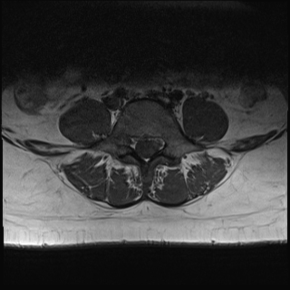 File:Normal lumbar spine MRI- 3 T (Radiopaedia 53280-59250 Axial 22).jpg