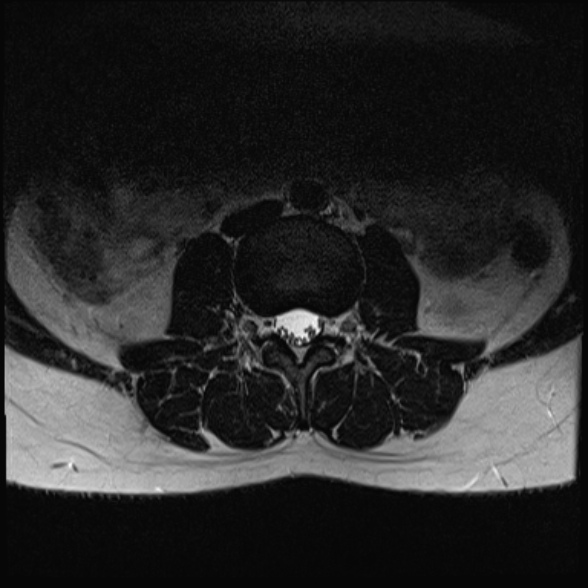 File:Normal lumbar spine MRI- 3 T (Radiopaedia 53280-59250 Axial T2 8).jpg