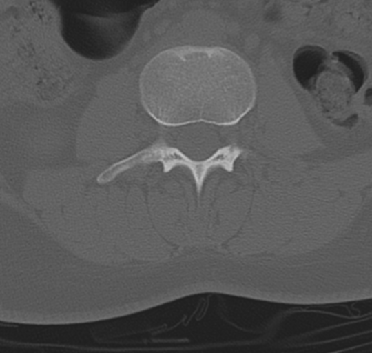 File:Normal lumbosacral CT (Radiopaedia 37923-39867 Axial bone window 53).png