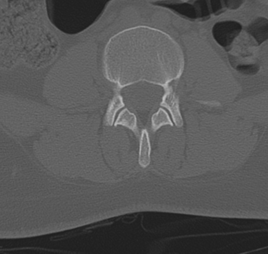 File:Normal lumbosacral CT (Radiopaedia 37923-39867 Axial bone window 59).png