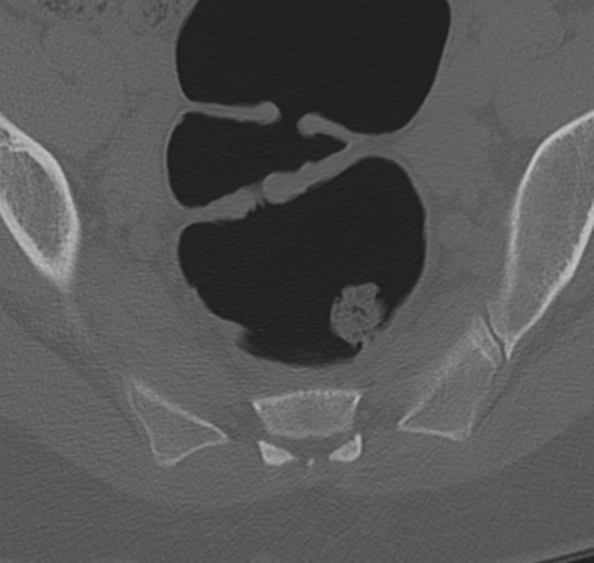 File:Normal lumbosacral CT (Radiopaedia 37923-39867 Axial bone window 97).png