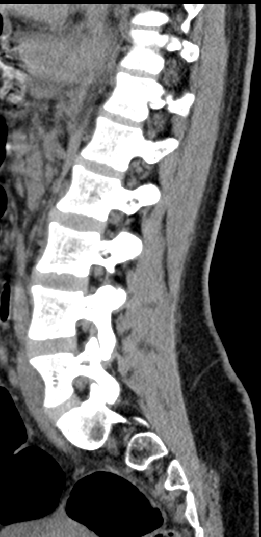 Normal lumbosacral CT (Radiopaedia 37923-39867 E 45).png