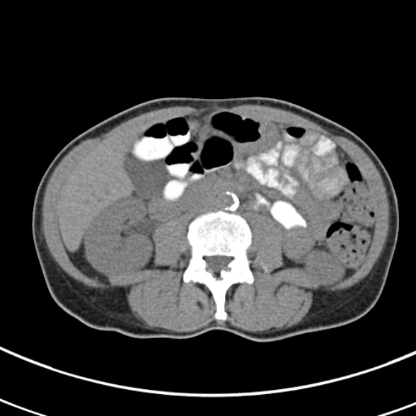 File:Normal multiphase CT liver (Radiopaedia 38026-39996 Axial non-contrast 42).jpg