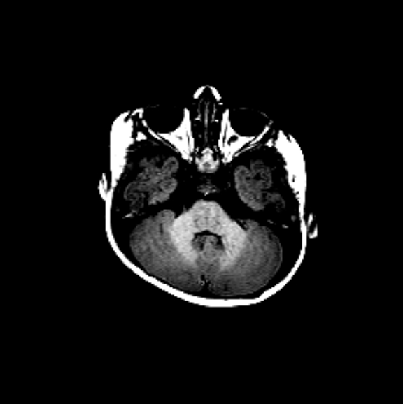 File:Normal myelination 5 month old (Radiopaedia 6814-7982 Axial T1 2).jpg