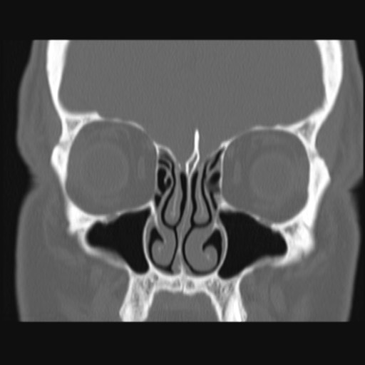 Normal sinus CT (annotated) (Radiopaedia 78917-91810 Coronal bone window 24).jpg