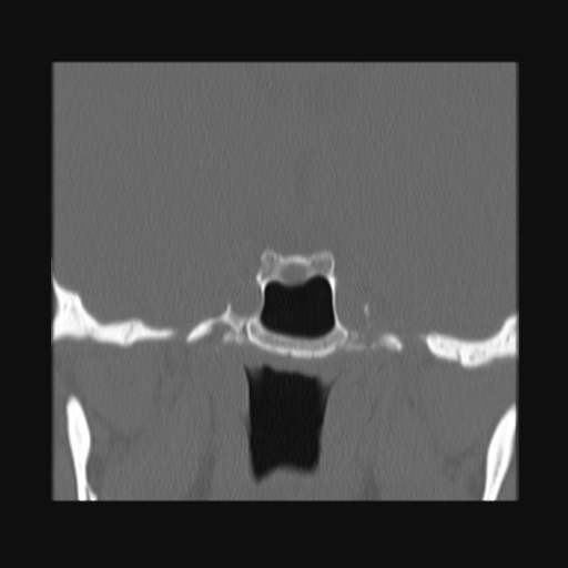 Normal sinus CT (annotated) (Radiopaedia 78917-91810 Coronal bone window 50).jpg