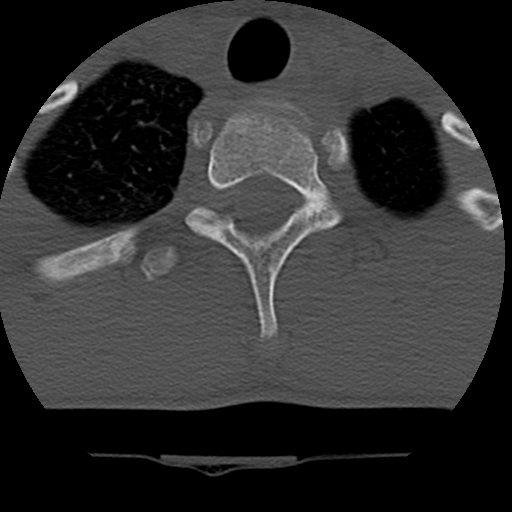 Normal trauma spine imaging (age 16) (Radiopaedia 45335-49358 Axial bone window 80).jpg