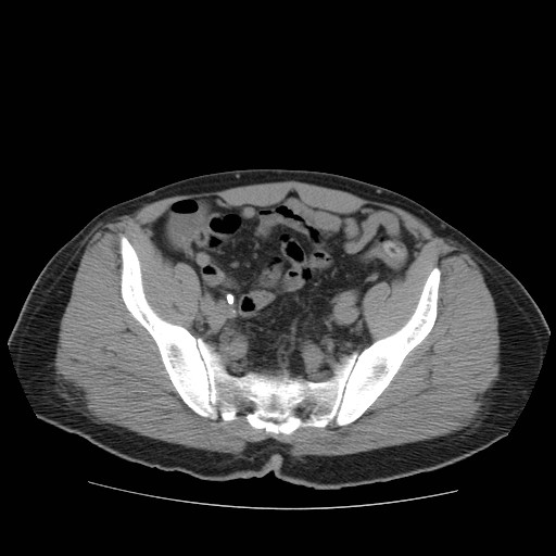File:Obstructed kidney with perinephric urinoma (Radiopaedia 26889-27067 Axial non-contrast 41).jpg