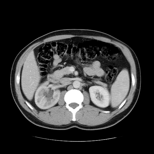 File:Obstructing ureteric calculus (Radiopaedia 18615-18514 B 21).jpg