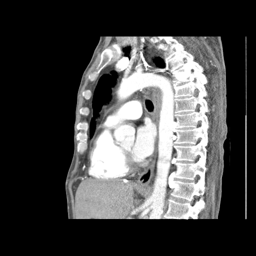 File:Obstructive superior vena cava tumor thrombus (Radiopaedia 28046-28306 B 1).jpg