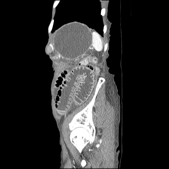 Obturator hernia causing small bowel obstruction (Radiopaedia 65522-74612 C 15).jpg