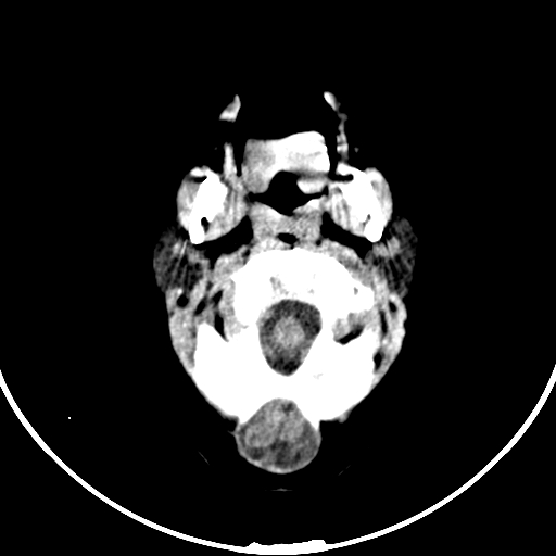 Occipital encephalocele (Radiopaedia 87339-103636 Axial non-contrast 14).jpg