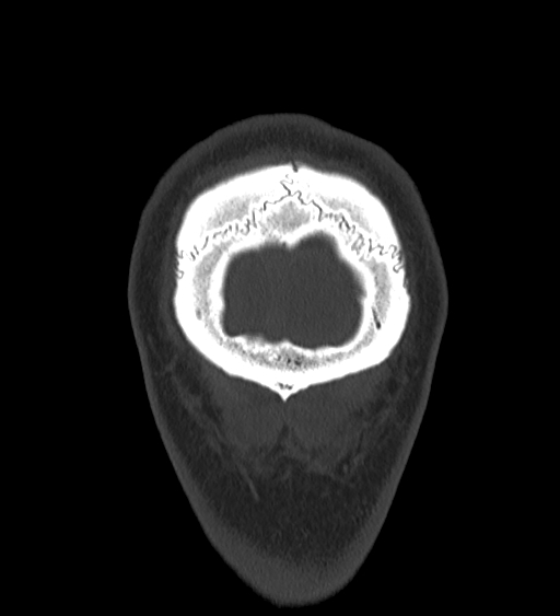 Occipital spur and Currarino type A atlas anomaly (Radiopaedia 87027-103285 Coronal bone window 139).jpg