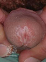 File:Penile lichen sclerosus (DermNet NZ 089-small).jpg