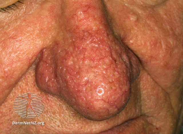 Rosacea (DermNet NZ acne-red-face-3651).jpg
