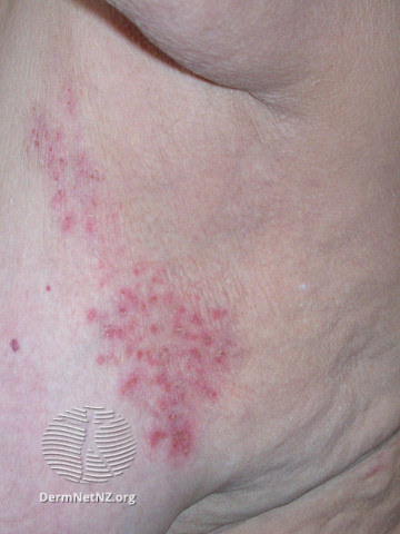 File:Subcorneal pustular dermatosis (DermNet NZ scaly-sneddwilk3).jpg