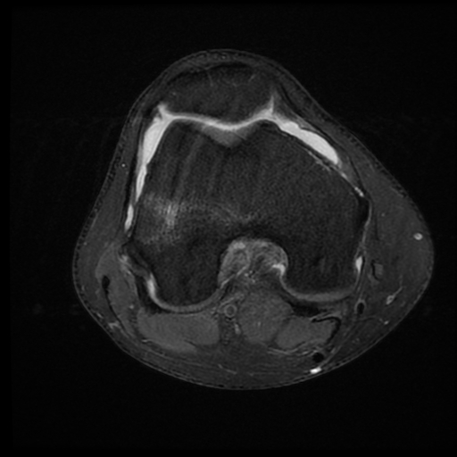 File:ACL acute full thickness tear - deep lateral femoral sulcus sign (Radiopaedia 38594-40740 Axial PD fat sat 12).jpg