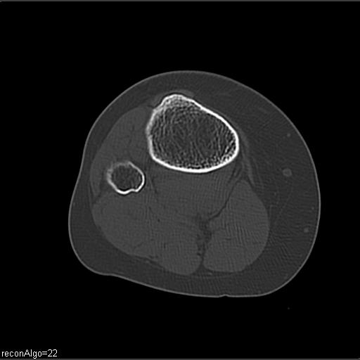 File:ACL avulsion fracture (Radiopaedia 33833-34994 Axial bone window 24).jpg