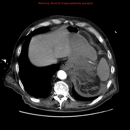 Abdominal aortic aneurysm- extremely large, ruptured (Radiopaedia 19882-19921 Axial C+ arterial phase 9).jpg