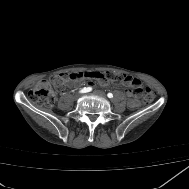 Abdominal aortic aneurysm (Radiopaedia 23703-23856 Axial C+ arterial phase 63).jpg