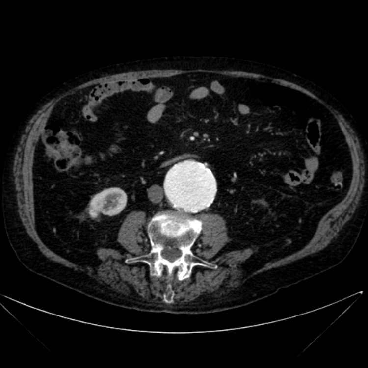 Abdominal aortic aneurysm (Radiopaedia 25855-26001 Axial C+ arterial phase 70).jpg