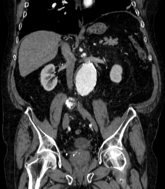 Abdominal aortic aneurysm (Radiopaedia 25855-26001 Coronal C+ arterial phase 37).jpg