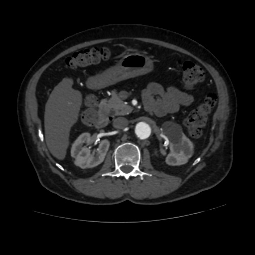 File:Abdominal aortic aneurysm (Radiopaedia 57318-64259 Axial C+ arterial phase 28).jpg