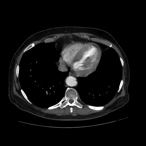 File:Abdominal aortic aneurysm (Radiopaedia 57318-64259 Axial C+ arterial phase 3).jpg
