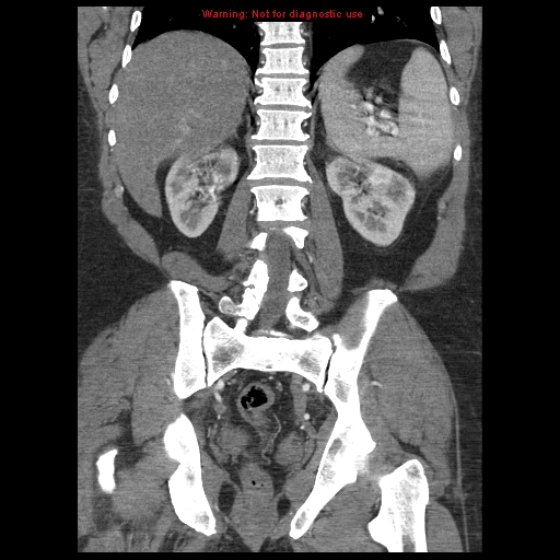 Abdominal aortic aneurysm (Radiopaedia 8190-9038 Coronal C+ arterial phase 90).jpg