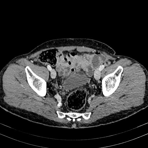 File:Abdominal aortic aneurysm (Radiopaedia 83581-98689 Axial C+ portal venous phase 96).jpg